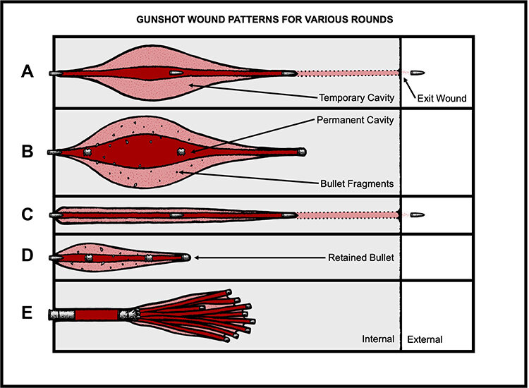 Gunshot wound patterns diagram